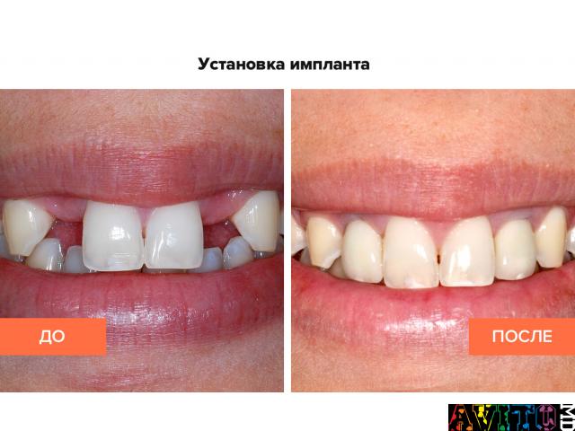 Надежно восстанавливаем зубы для счастливой улыбки