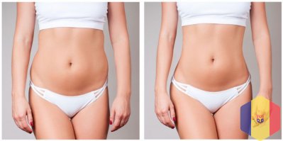 BodyTite: современная радиочастотная липосакция без боли