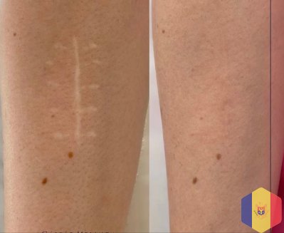 Tratament cu laser pentru indepartarea si eliminarea, (corectia) cicatricelor in cabinetul de chir