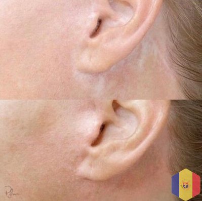 Tratament cu laser pentru indepartarea si eliminarea, (corectia) cicatricelor in cabinetul de chir