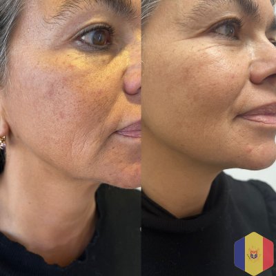 Face lift "Nefertiti" prin metoda 3D HIFU SMAS