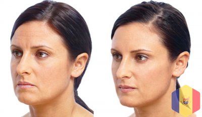 Face lift "Nefertiti" prin metoda 3D HIFU SMAS