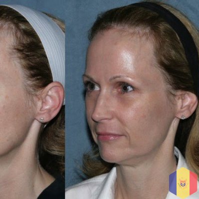 Подтяжка лица "Нефертити" методом 3D HIFU ультразвуковой SMAS-лифтинг!