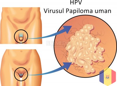 Condiloame genitale: îndepărtarea laser a verucilor genitali si condiloamelor in Moldova ( Chisinau