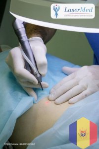 Condiloame genitale: îndepărtarea laser a verucilor genitali si condiloamelor in Moldova ( Chisinau