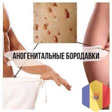 Лазерное удаление кондилом и генитальных бородавок в Кишиневе, Молдове!