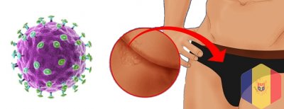 Лазерное удаление кондилом и генитальных бородавок в Кишиневе, Молдове!