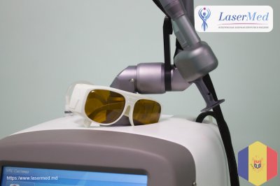 Лазерное удаление (коррекция) вросшего ногтя в Кишиневе, Молдове!