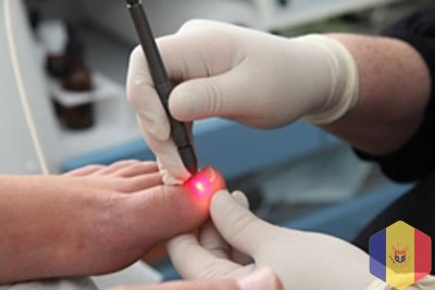 Corectie laser (Tratament laser) a unghiei incarnate