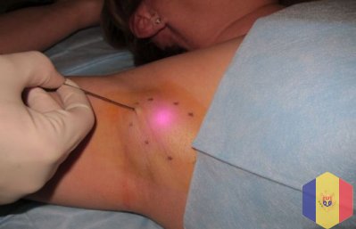 Лечение гипергидроза (потливости) подмышек лазером в Молдове!