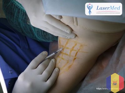 Tratamentul cu laser a hiperhodrozei axilare in Moldova!