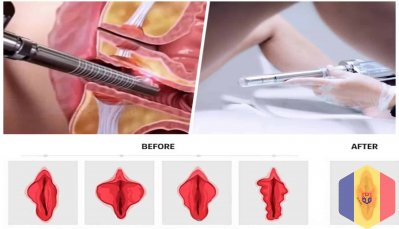 Reintinerirea vaginului cu laser sau rejuvenare vaginala (vaginoplastie cu laser) in Moldova!