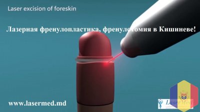 Лазерная френулопластика, френулотомия в Кишиневе!