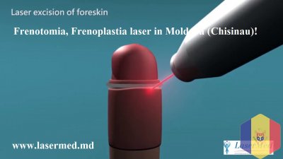 Circumcizia cu laser (ablatia laser a preputului) la bărbații in Moldova