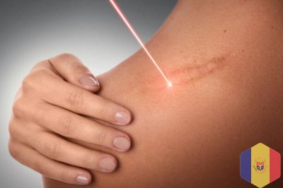 Tratament cu laser pentru indepartarea si  eliminarea, (corectia) cicatricelor  in cabinetul de chir