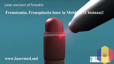 Frenotomia, Frenoplastia laser in Moldova (Chisinau)!