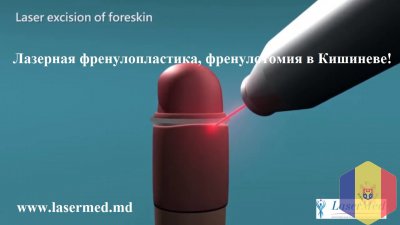 Лазерная френулопластика в Молдове (Кишиневе)!