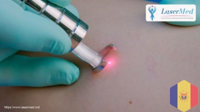Tratamnentul laser a leziunilor vasculare (telangiectazii, capilare sparte, cuperoza,