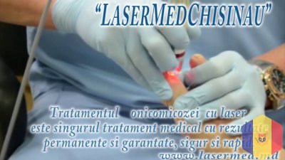 Tratament laser a onicomicozei in Moldova Tratament laser a onicomicozei (Infectia fungica a unghie