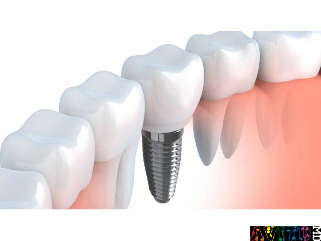 Зубные импланты: Ровная и красивая улыбка за 4 визита к стоматологу